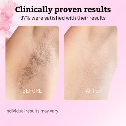 Cyperus Rotundus Oil for Hair Reduction